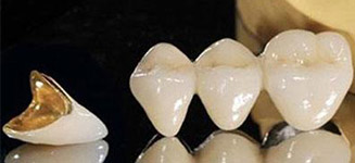 牙冠材料的不同